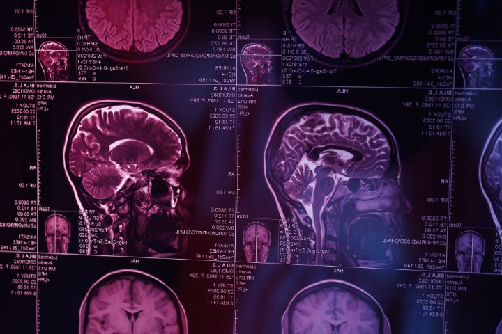 La Esclerosis Lateral Amiotrófica (ELA) como enfermedad neurodegenerativa: Perfil neuropsicológico y actuaciones clínicas
